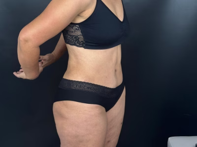 Abdominoplastia post-bariátrica: retiro de piel tras gran pérdida de peso Abdominoplastia post-bariátrica ALMO Clinic