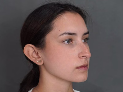 Antes y después de Rinoplastia Antes de rinoplastia en ALMO Clinic