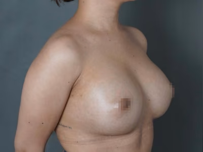 Aumento mamario con implantes: volumen y forma natural Aumento mamario en ALMO Clinic