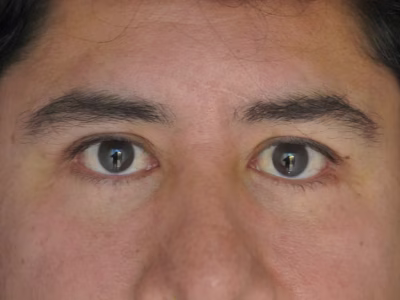 Turismo médico cirugía plástica Colombia — ALMO Clinic Blefaroplastia en Bogotá cirugía de párpados con resultados naturales para pacientes internacionales en ALMO Clinic Bogotá