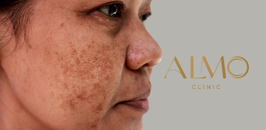 Melasma in Pregnancy: Hormonal Spots and How to Manage Them | ALMO