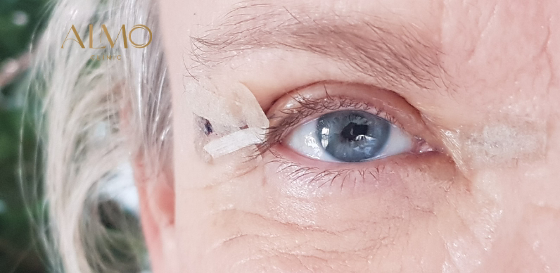 Antes y después de Blefaroplastia Resultado antes y después de blefaroplastia en Bogotá