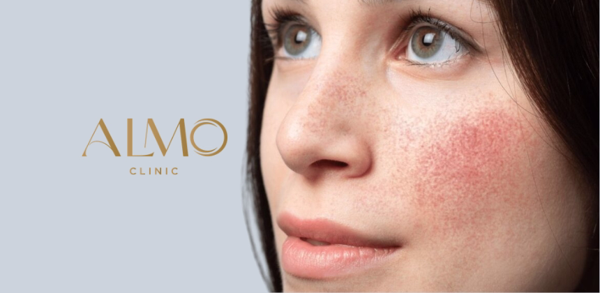 Rosacea Causes and Triggers: Why Flare-Ups Happen | ALMO Clinic
