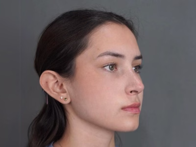 Resultado de rinoplastia en ALMO Clinic Bogotá
