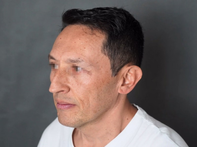 Lifting facial: rejuvenecimiento quirúrgico del rostro y el cuello Lifting facial en ALMO Clinic Bogotá