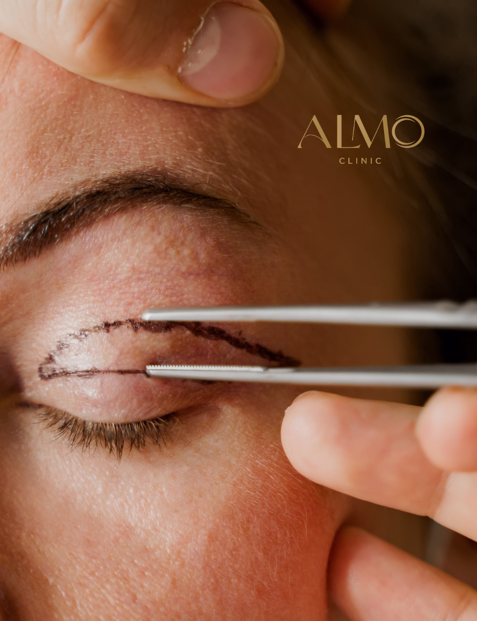 Resultado final blefaroplastia Bogotá — mirada natural y rejuvenecida ALMO Clinic Resultado blefaroplastia en Bogotá — mirada descansada y natural antes y después cirugía de párpados ALMO Clinic
