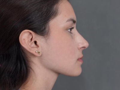 Rinoplastia ultrasónica: perfil nasal armónico y natural Rinoplastia ultrasónica en ALMO Clinic Bogotá — corrección nasal natural